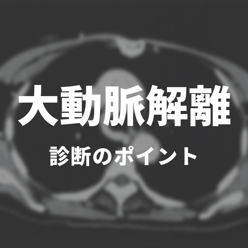 大動脈解離　診断のポイント